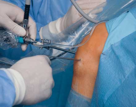 ACL rehab surgery