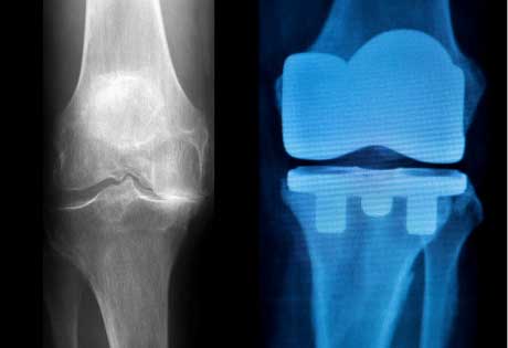 Knee operation recovery