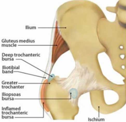 Bursitis diagnosis and prevention