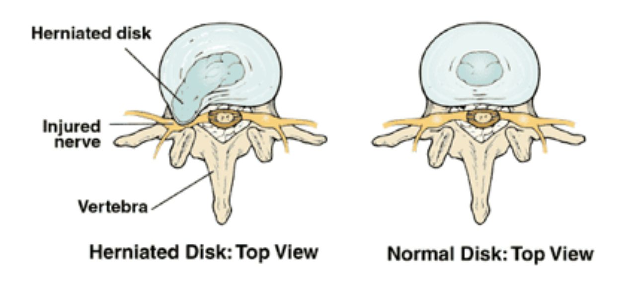 How to treat, prevent and diagnose herniated disk